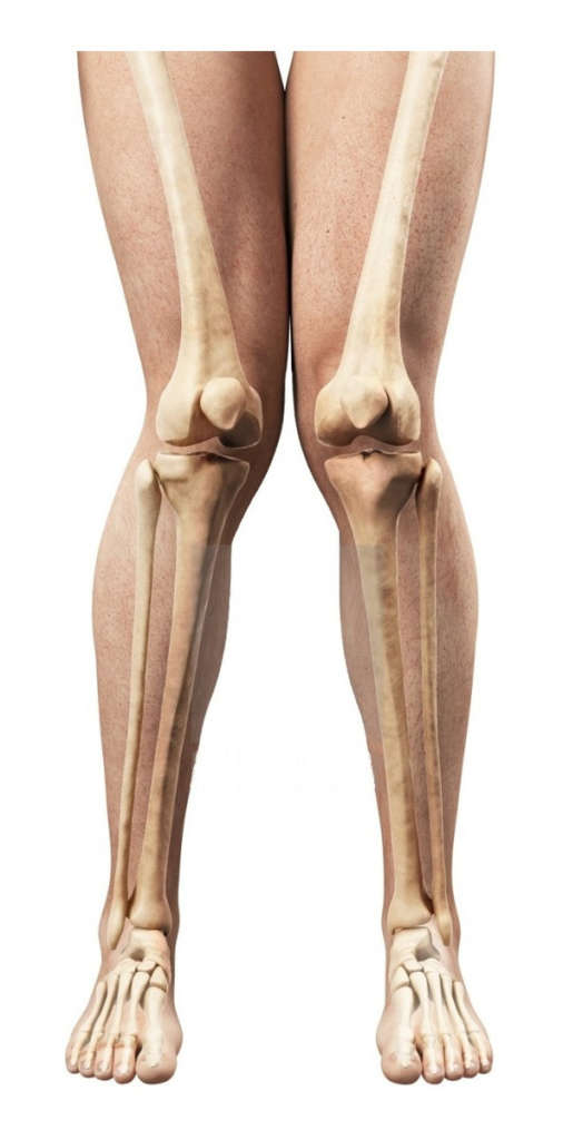 Joelho valgo ou "pernas de tesoura" é mais comum em mulheres
