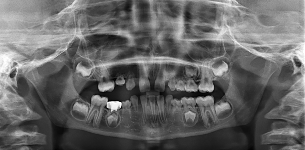 Osteogenes imperfecta