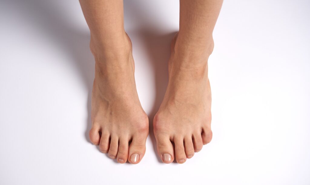 Imagem dos pés em joanete