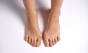 Imagem dos pés em joanete