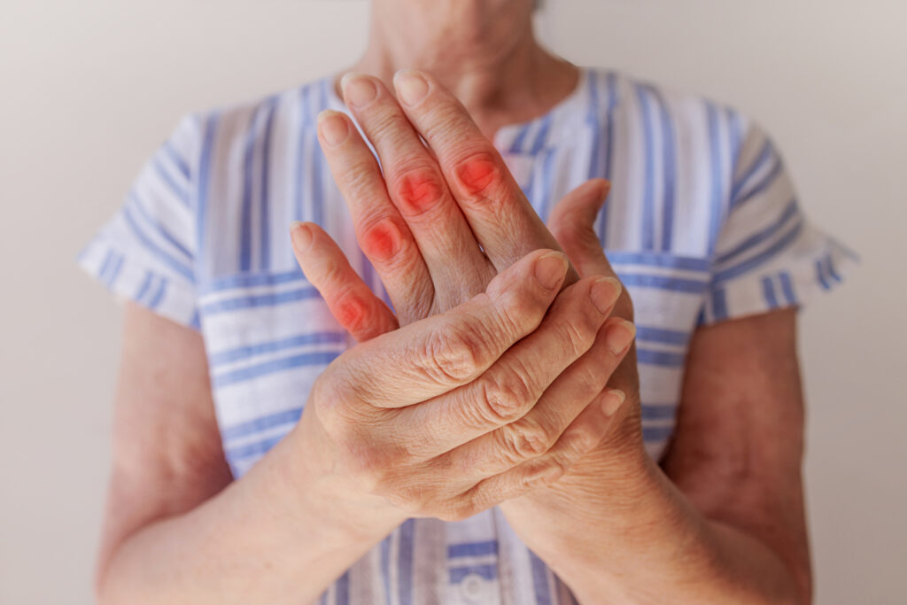 Mulher com artrite na mão