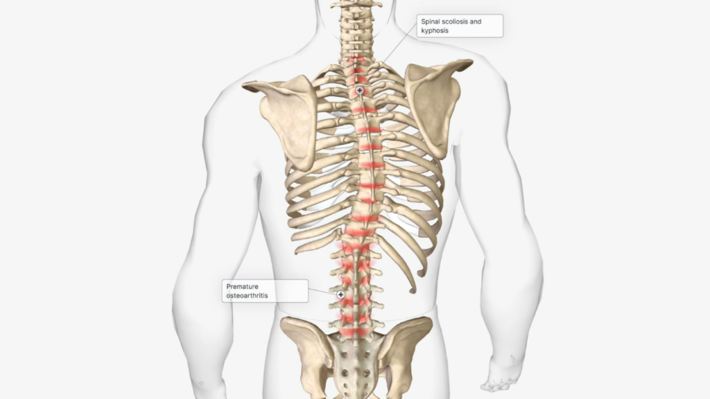 Coluna vertebral com escoliose, para falar sobre a correção desse problema