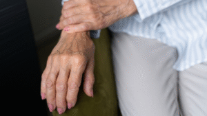 Mão de uma mulher com artrite reumatoide, para falar sobre os tratamentos